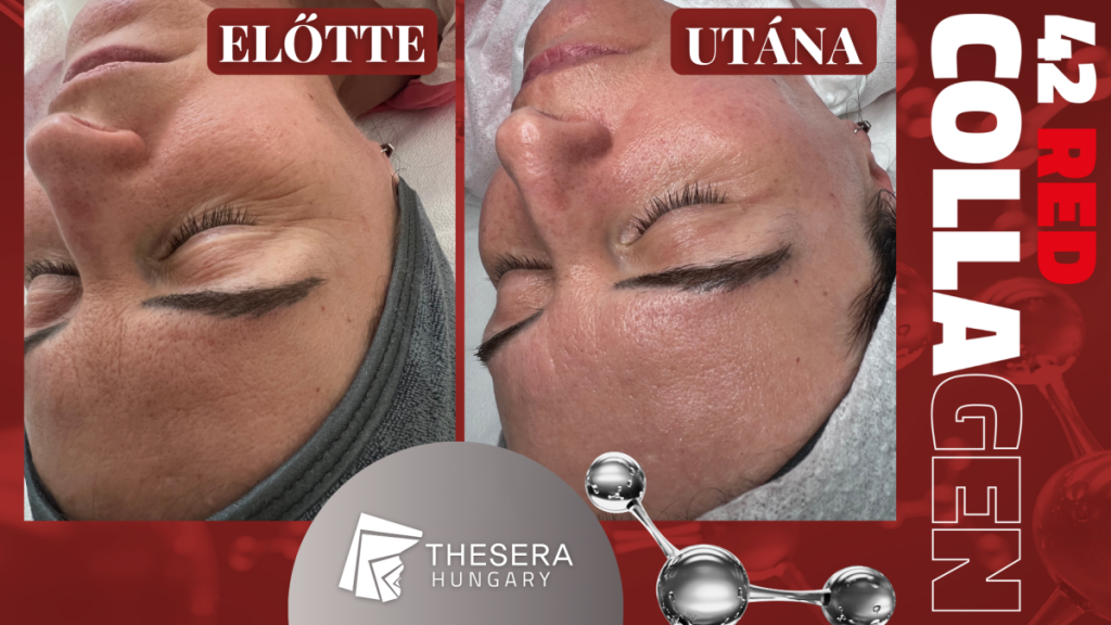 Thesera 42 Red Collagen kezelés — előtte-utána eredmény